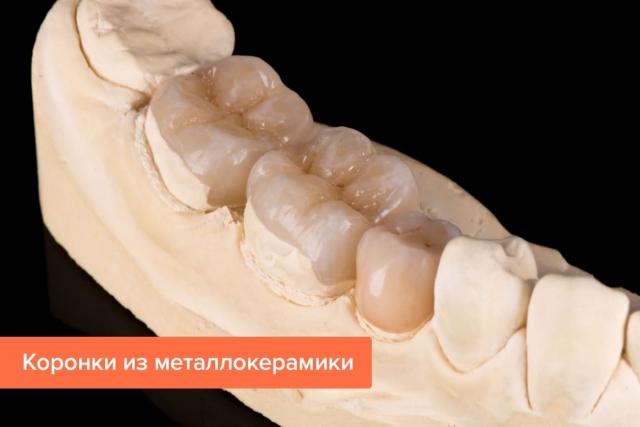Коронки на передние и жевательные зубы: какие выбрать?